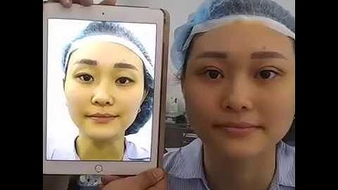 [Trực Tiếp] Kết Quả Cắt Mí Mini Deep - VTM Y Khoa Dr.Hải Lê