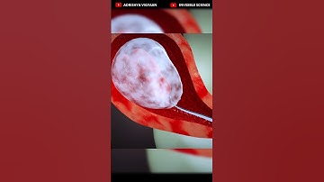 Understanding Abortion: 3D Animation Explaining D&E Procedures | Dilation and Evacuation