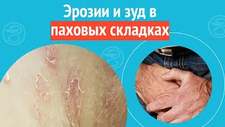 👉 Эрозии И Зуд В Паховых Складках. Клинический Случай №1228