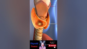 Goiter ※ Thyroid Tumor 💉Radiofrequency Ablation ┬┬ RFA