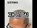 #남성탈모 #두피문신 #원형탈모 #여성탈모