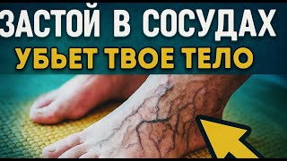 Тромбы в ногах развиваются НЕЗАМЕТНО! Вот что нужно сделать сейчас!