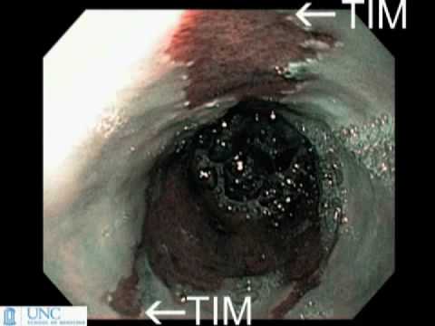 NEJM Procedure: Radiofrequency Ablation in Barretts Esophagus with Dysplasia