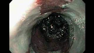 NEJM Procedure: Radiofrequency Ablation in Barretts Esophagus with Dysplasia screenshot 4