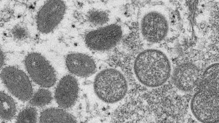 More Monkeypox in Dallas: 2 new cases confirmed