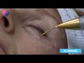 Rejuvenescimento de palpebra inferior com Jett Plasma