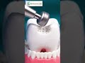 Satisfying Silver to White Dental Transformation! ✨ #shorts #dentistry #asmr #viral