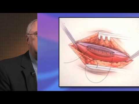importance of fistula first approach to dialysis access youtube