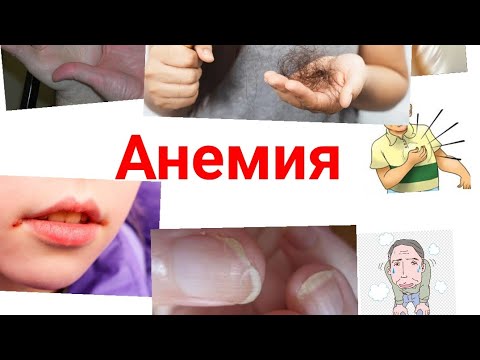 Бейне: Анемиялық гипоксия дегеніміз не?