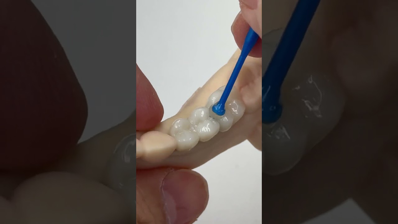 3 unit bridge with two implants! 