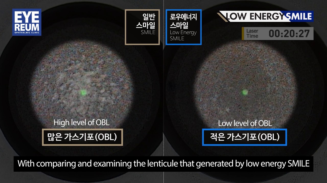 [Айриум нүдний эмнэлэг] [EYERUEM] Бага энерги SMILE синема