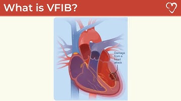 What is Ventricular Fibrillation (VFIB)?