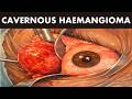 CAVERNOUS HAEMANGIOMA