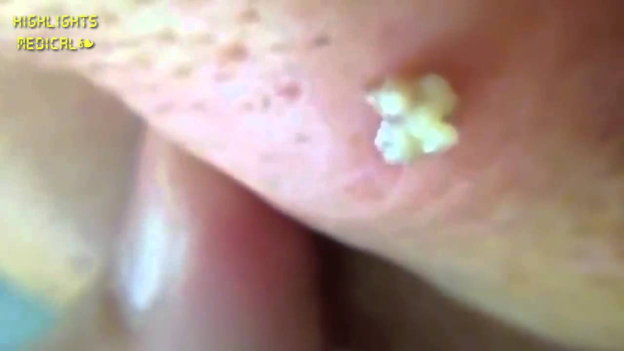 Sebaceous Cyst Sac Removal ! AWESOME cyst on the back - YouTube
