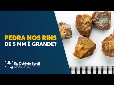 Vídeo: Você pode passar uma pedra nos rins de 5mm?