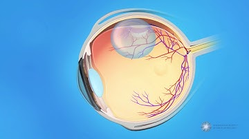 Pneumatic Retinopexy for Detached Retina