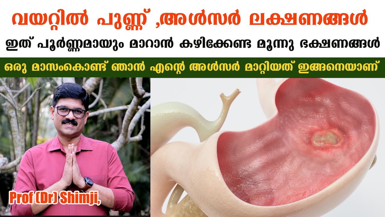 എത്ര പഴകിയ അൾസറും പമ്പകടക്കും ഇത് കഴിച്ചാൽ /Ulcer Malayalam