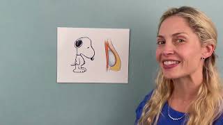 What is a Snoopy Breast deformity?