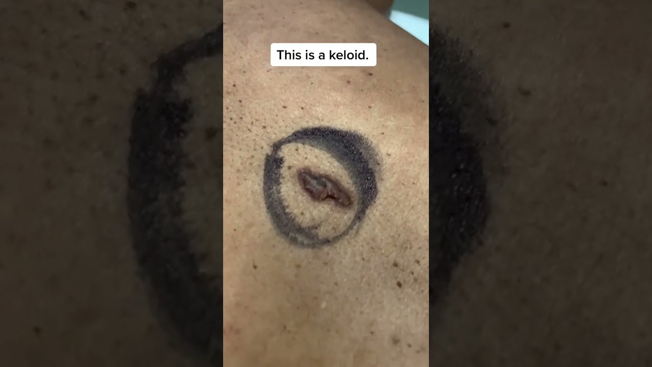 Keloid Scar Removal Shorts