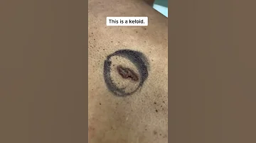 Keloid Scar Removal Shorts 