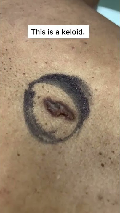 Keloid Scar Removal #shorts