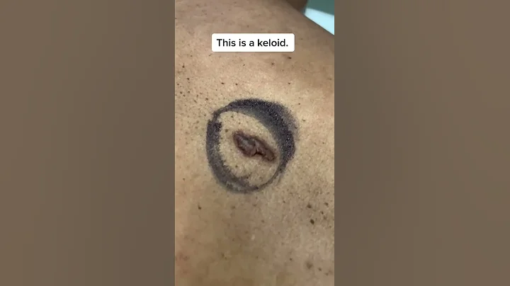Keloid Scar Removal #shorts - DayDayNews