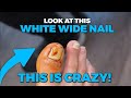 THIS WHITE WIDE NAIL IS LIFTED?!!