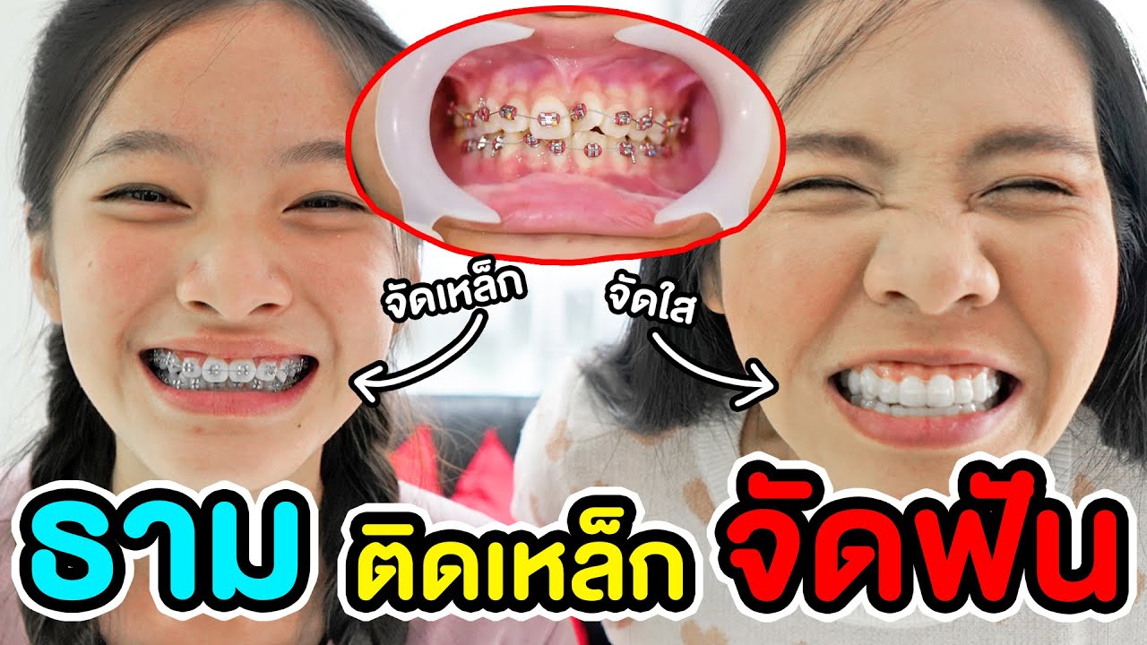 ธามติดเหล็กจัดฟัน เจ็บมั๊ย?! | Q \u0026 A พี่เฟิร์น 108Life