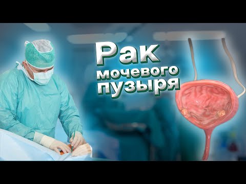 Трансуретральная резекция мочевого пузыря. Опухоль мочевого пузыря. Рак лоханки почки