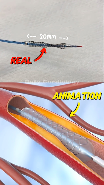 Real vs Animation: How a Stent is Placed in Angioplasty | Heart Procedure Explained #Shorts