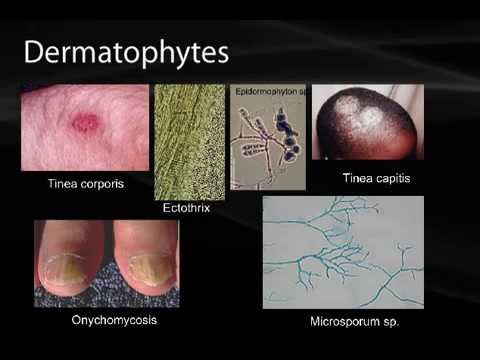 Dermatophytosis - Wikipedia