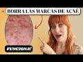 🔴Cómo ELIMINAR MARCAS de ACNÉ | 4 REMEDIOS para MANCHAS de ACNÉ