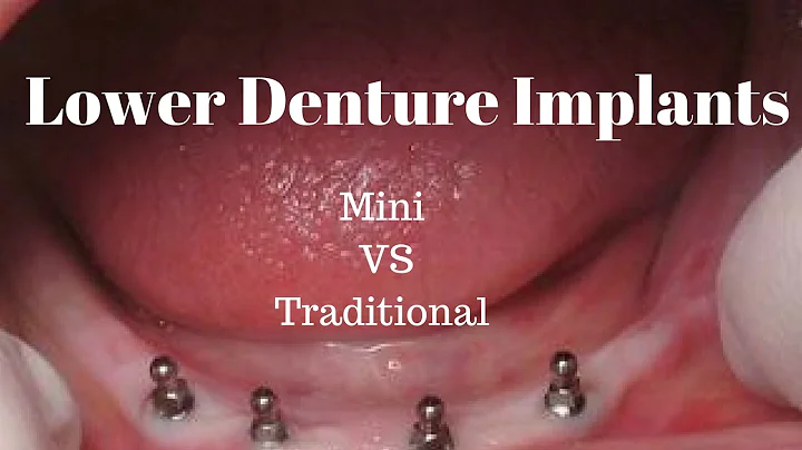 Lower Denture Implants:  Mini vs Traditional