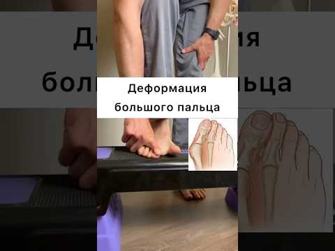 ✅Упражнение при вальгусной
