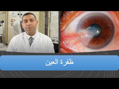 ظفرة العين الأسباب و العلامات وطرق الوقاية والعلاج