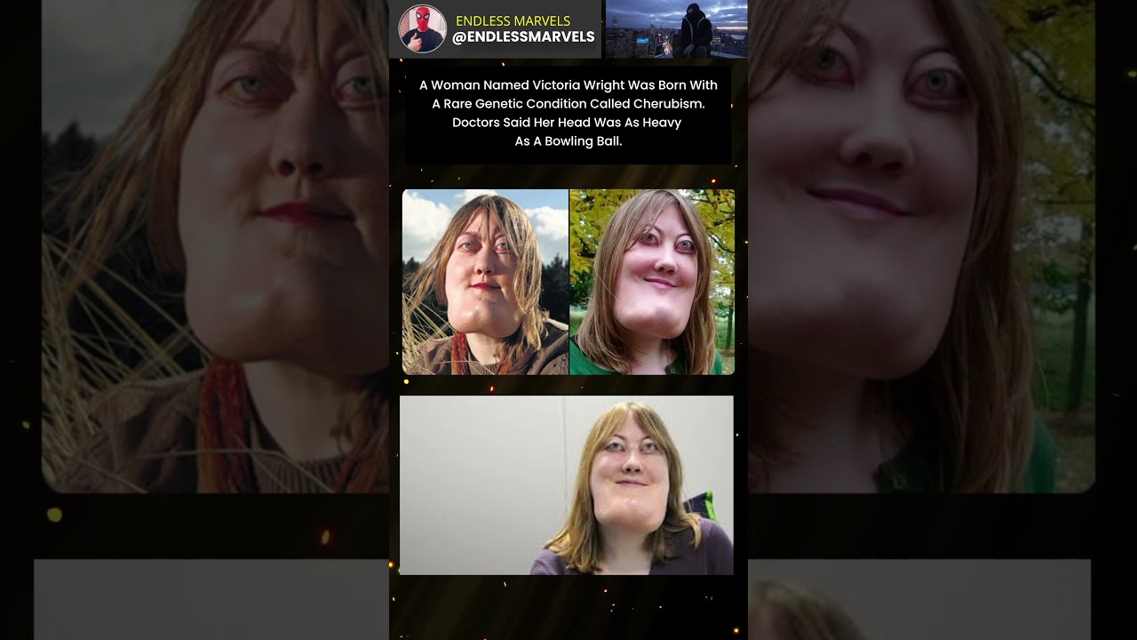 Victoria Wright’s Rare Condition Made Her Head Heavy 