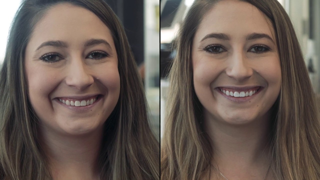 Teeth Whitening at SHADE Sunless Spa YouTube