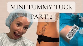 The real truth of having a mini tummy tuck | PART 2