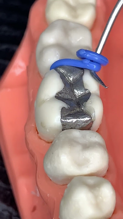 🔥DENTAL SPACERS🔥