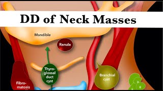 Differential Diagnosis of Neck Masses by ASM Minds Team