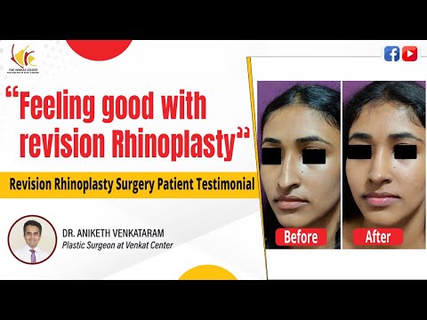 Revision Rhinoplasty: Nose