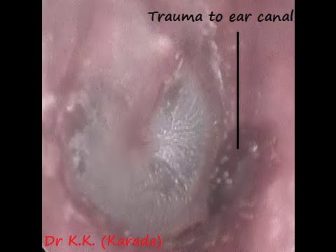 Look inside view of ear after cotton bud Q Tip itching or cleaning