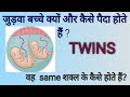 MULTIPLE PREGNANCY -" Twins" Full explanation in hindi | ADVANCE NURSING TIP'S |