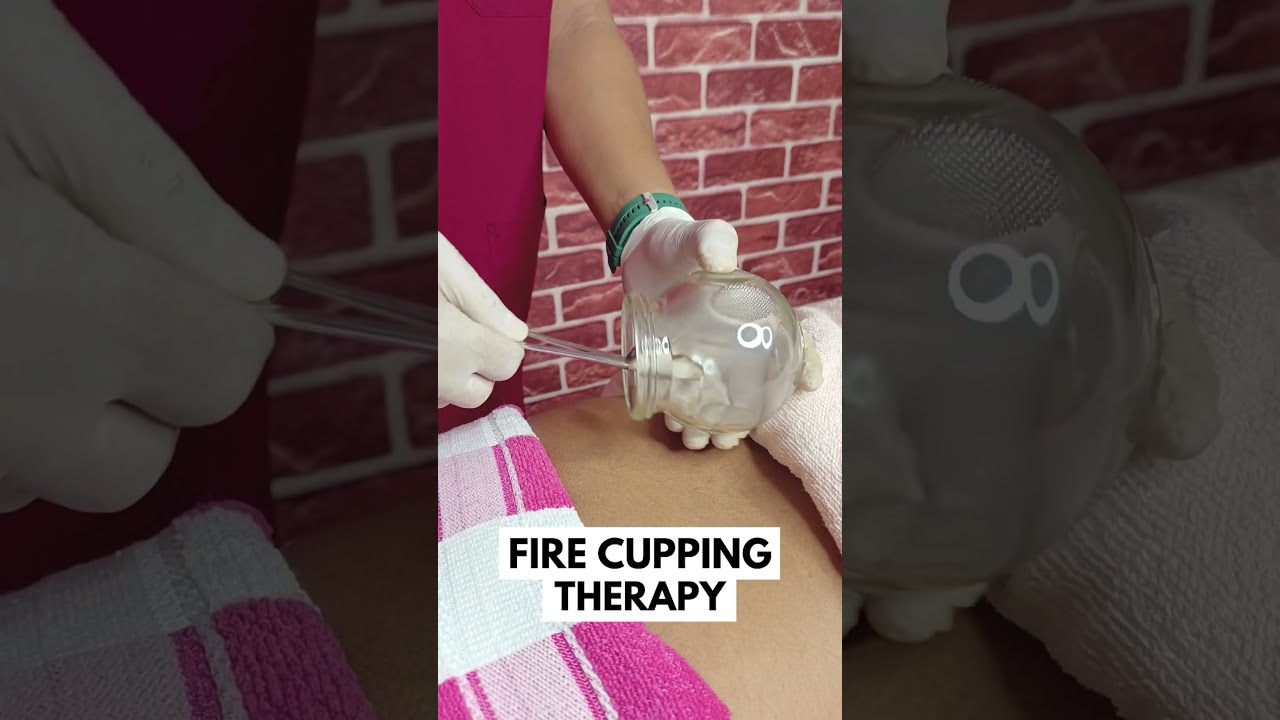 CUPPING THERAPY Hijamacupping Cuppingtherapy