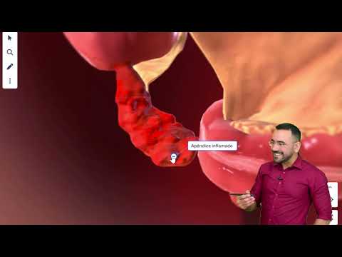 COMO É FEITO A CIRURGIA DE APENDICITE? (APENDICECTOMIA)