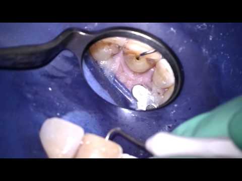 Dévitalisation dentaire (traitement du canal dentaire)