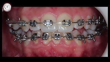 class III by dr amr asker