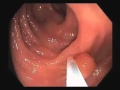 Colonoscopy tour removal of a colon polyp polypectomy