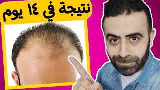 بودرة املا الاصلي اكسير الحياة للصلع و انبات الشعر و تكثيف و اطالة شعر اللحية Amla Powder For Hair