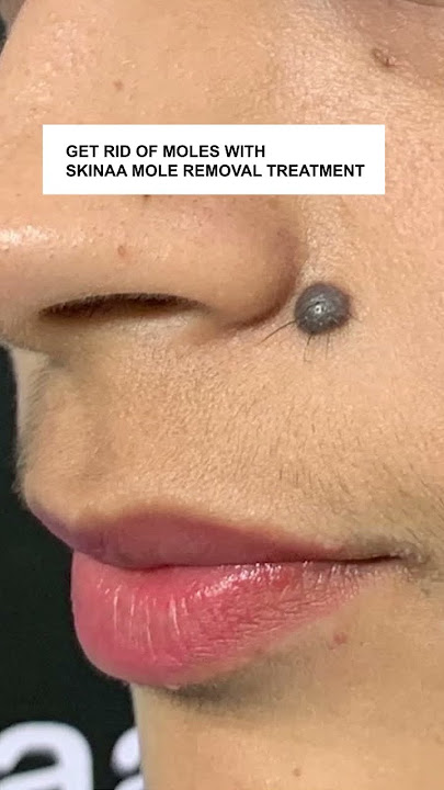 Best Mole Removal Treatment at Skinaa Clinic #Viral